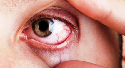 Cerca de 180 mil capitalinos padecen glaucoma, la mitad no lo sabe: Ahued