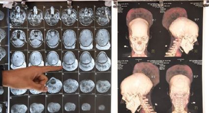 Extraen un tumor cerebral de casi dos kilos en India (FOTOS) 
