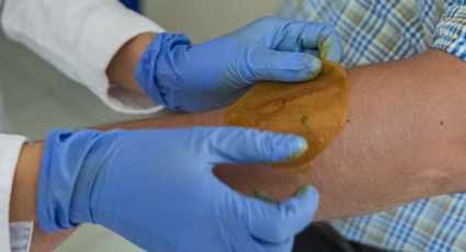 UNAM presenta parche que regenera piel de diabéticos en menor tiempo