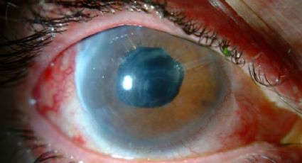 IMSS alerta que glaucoma es la principal causa de ceguera en el mundo