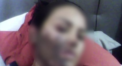 FGE investiga agresión con ácido contra mujer en Querétaro