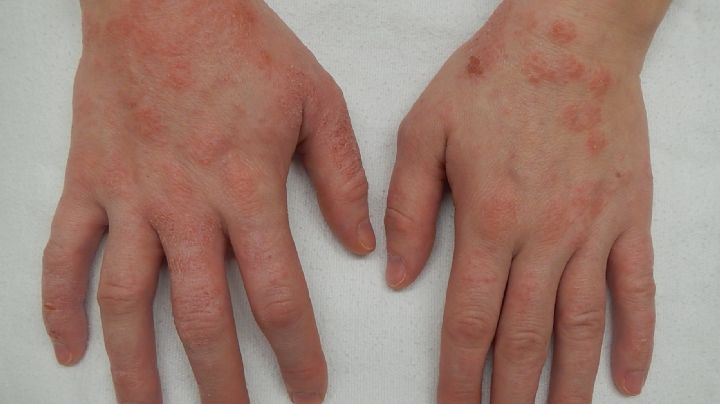 ¿Qué es la dermatitis atópica? La mutación de un gen entre sus causas