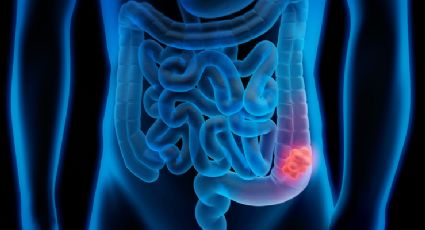 ¿Qué es el cáncer de colon? ¡Se puede prevenir!