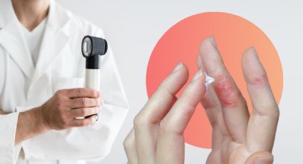 ¿Qué es la dermatitis atópica y cómo prevenirla?