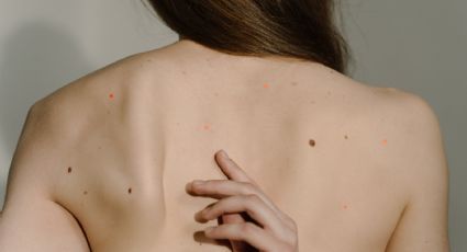 ¿Tienes puntos rojos en la piel? Este es su verdadero significado