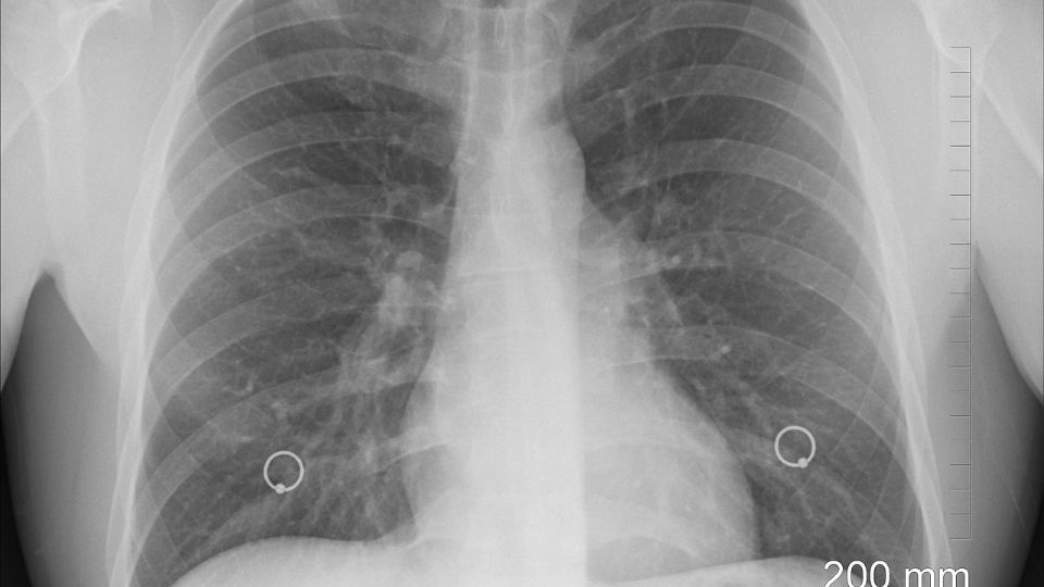 Medicina para tratar la fibrosis pulmonar creada por IA, ya fue probada en un paciente.