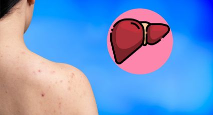 3 tipos de manchas en la piel que aparecen cuando falla el hígado