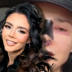 Dorismar: ¿Quién es la actriz que reapareció con el rostro desfigurado tras cirugía estética?