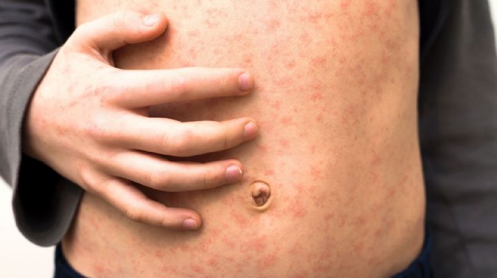 Se investiga si dos muertes en CDMX fueron a causa de sarampión