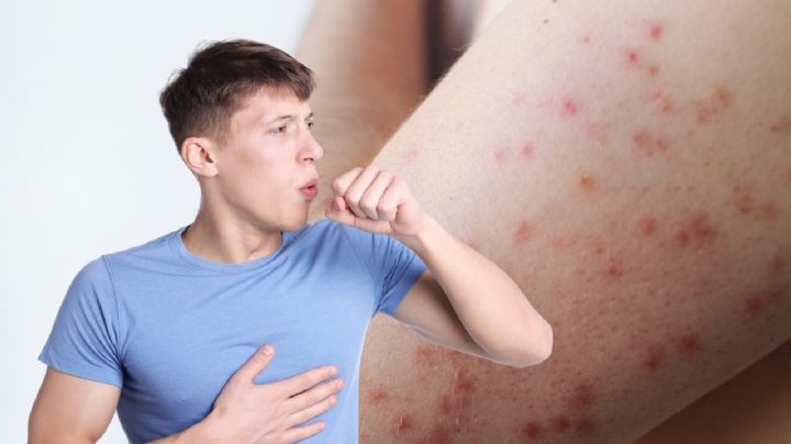 Muere otra persona en México a causa del sarampión