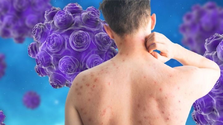 Confirma salud 11 mil 889 casos de sarampión en México