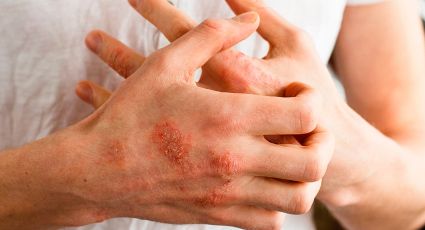 Dermatitis atópica: claves para prevenir brotes y proteger tu piel
