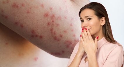 Salud confirma tres nuevos casos de sarampión en Nuevo León; ya suman 43 este 2026