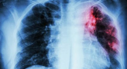 En México, la tuberculosis es la primera causa de muerte en adultos por enfermedades indeccionas: SSA