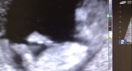 Ultrasonido muestra a bebé jugando a la "resbaladilla" (VIDEO)