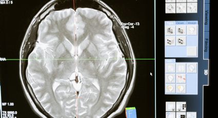 ¿Cuál es la diferencia entre un ictus y un derrame cerebral? Son muy similares