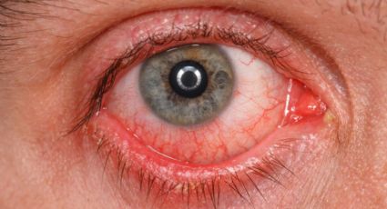 Ojo rojo: Un padecimiento común, pero que puede ser síntoma de que algo no está bien