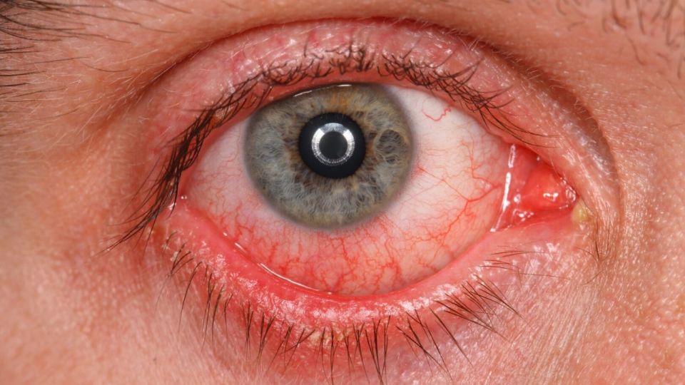 El ojo rojo puede ser síntoma de que algo no está bien y es momento de ir al médico para que diagnostique.