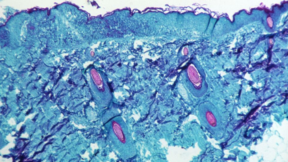 Una sección de tejido de piel, extraído de una lesión en la piel de un mono, que había sido infectada con el virus de la viruela del mono