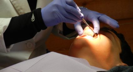 Joven español termina con la cara hinchada tras ir al dentista en México: VIDEO