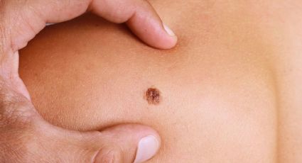 Melanoma: Conociendo, identificando y previniendo el cáncer de piel más peligroso