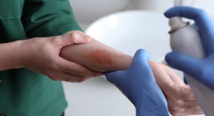 DIF Nuevo León ofrecerá cirugías reconstructivas gratuitas a menores con quemaduras