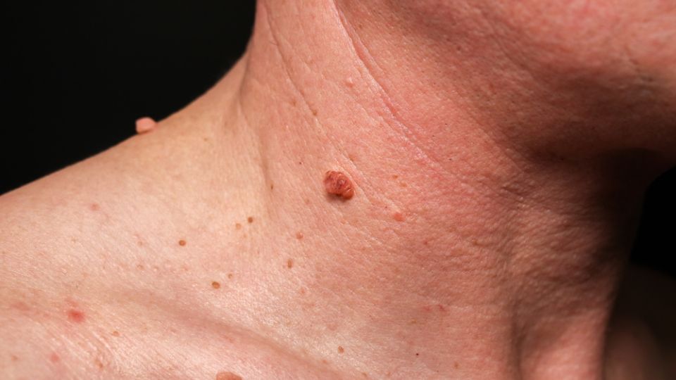 ¿Por qué salen verrugas en el cuello? Esto podría pasarte si te arrancas una