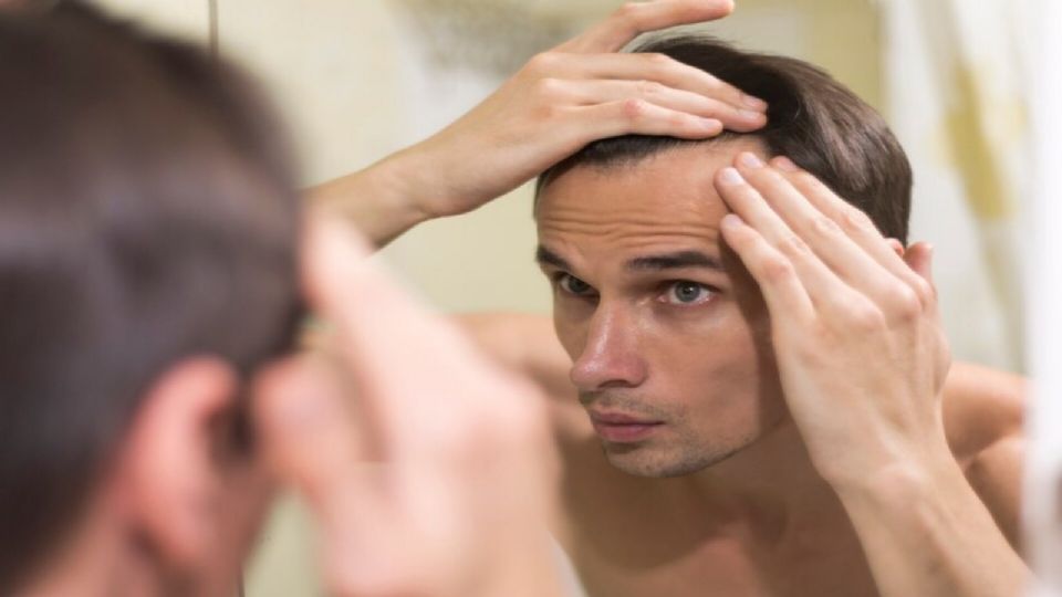 Los tratamientos para las entradas de cabello son múltiples; también puedes intentar con hábitos más saludables.