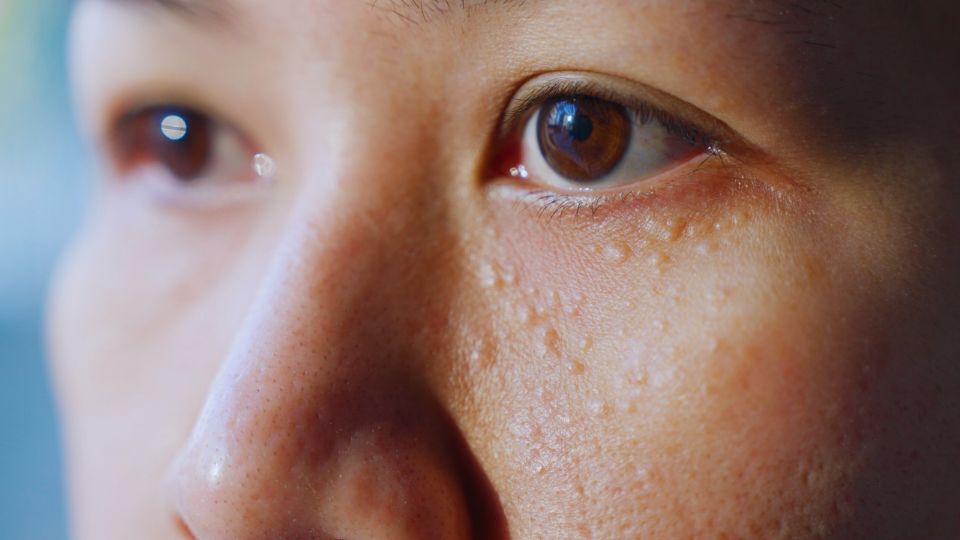 Quistes milia: qué son y cómo eliminarlos según dermatólogos