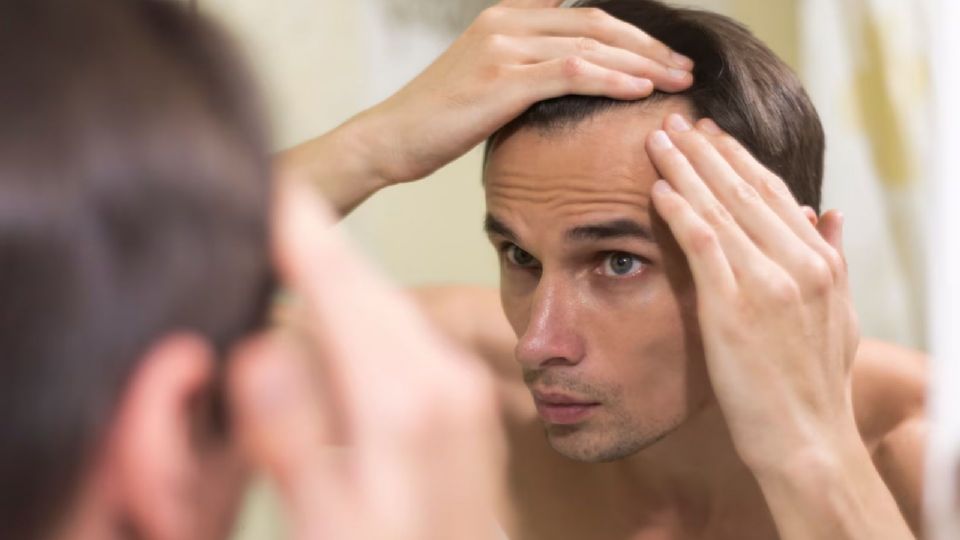 Descubre qué es la alopecia y cómo puede afectar a hombres y mujeres en el Día Mundial de los Calvos.