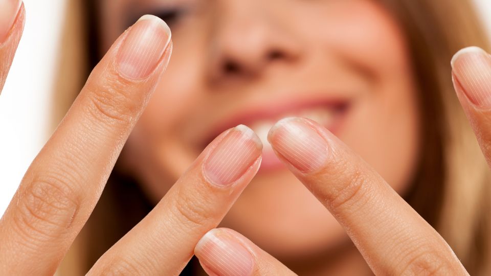 ¿Tus uñas tienen rayas? Esta puede ser la causa