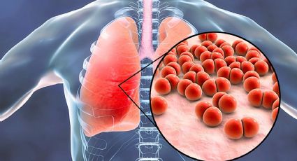 Día Mundial contra la Neumonía: Qué es y cuáles son los síntomas