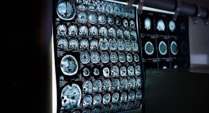 Estudio vincula que tener sobrepeso da grandes probabilidades a padecer Alzheimer