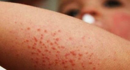 Cancelan clases por brote de Coxsackie en Puebla: ¿cómo se contagia y cuáles son los síntomas?