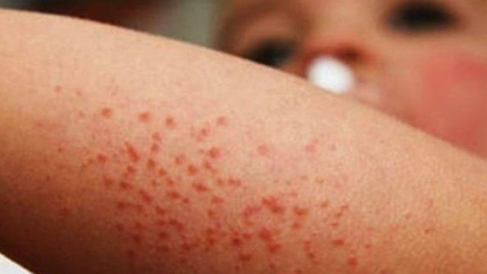 Cancelan clases por brote de Coxsackie en escuela de Puebla
