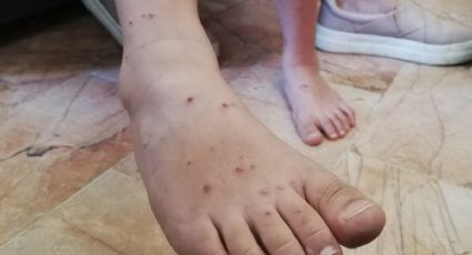 Varicela en México: estados con más contagios en el país