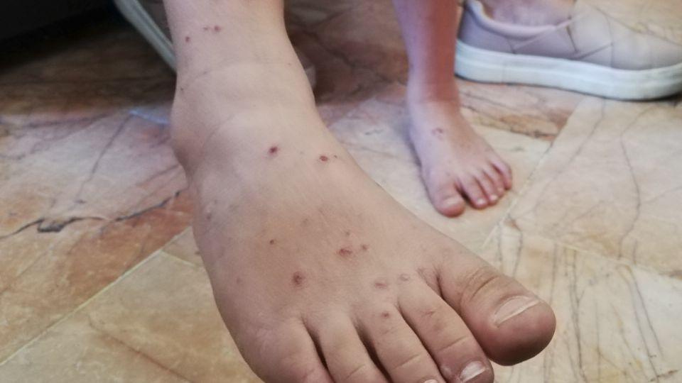 Estados con más casos de contagios de varicela en México