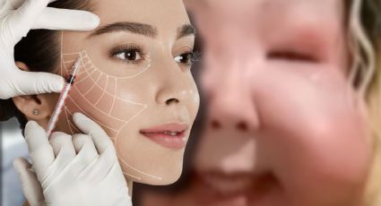 Influencer denuncia inyecciones ilegales; comienza una cirugía para recuperar su rostro