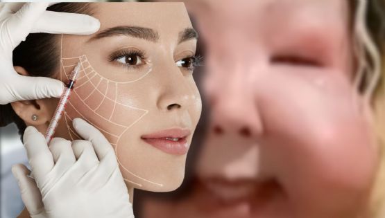 Influencer denuncia inyecciones ilegales; comienza una cirugía para recuperar su rostro