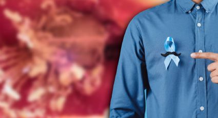 Cáncer de próstata: la guía de un médico para la prevención y el diagnóstico oportuno