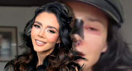Dorismar: ¿Quién es la actriz que reapareció con el rostro desfigurado tras cirugía estética?