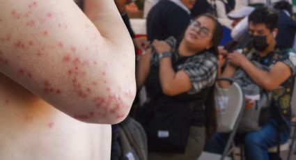 Sarampión en Chiapas: autoridades llaman a vacunarse ante aumento de casos y riesgo de contagio