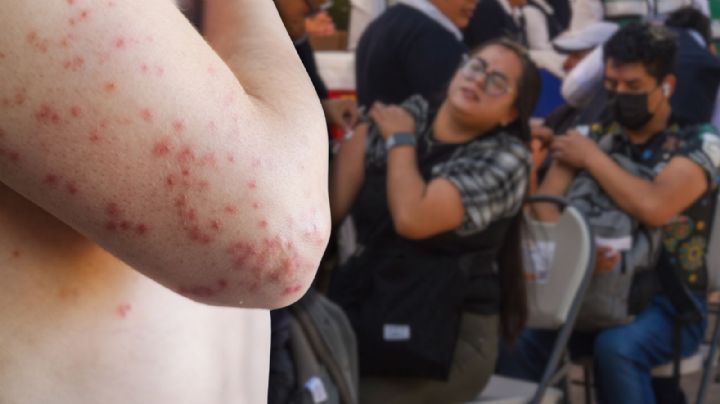 Sarampión en Chiapas: autoridades llaman a vacunarse ante aumento de casos y riesgo de contagio