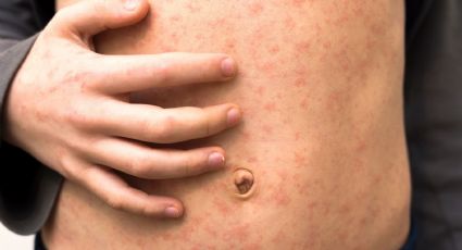 Sarampión en CDMX: confirman cinco contagios y activan protocolo de prevención