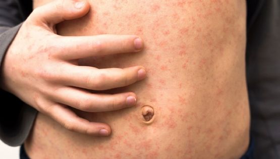 Sarampión en CDMX: confirman cinco contagios y activan protocolo de prevención