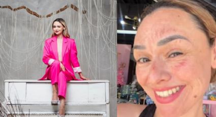 VIDEO | Influencer se quema el rostro en su cumpleaños por hacer trend viral