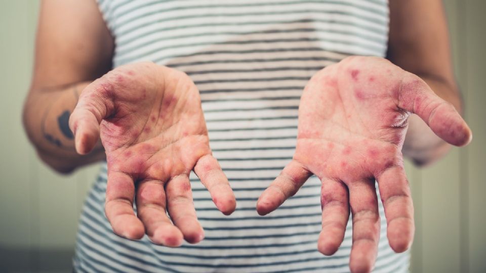 No hay excusa alguna para no garantizar la vacuna contra el sarampión en el país, dice el diputado.