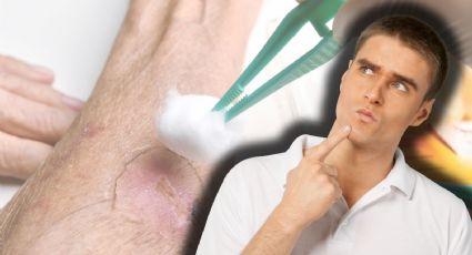 Miasis: ¿Qué es y por qué tiene a México en alerta epidemiológica?