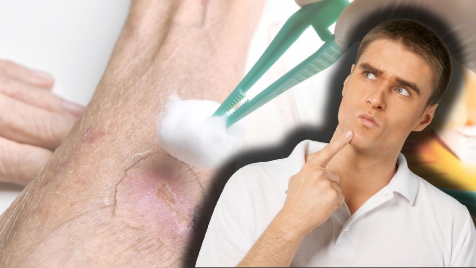 ¿Vives en zona de riesgo? Protege heridas y acude al médico si ves lesiones con movimiento.