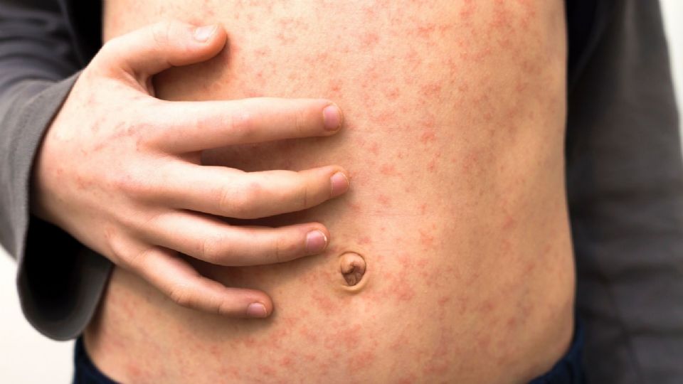 El secretario de salud recomendó la vacunación para la población de 1 a 49 años.